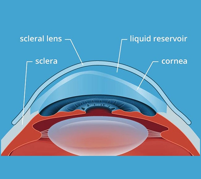 Keratoconus - Precise Vision - Warrawong